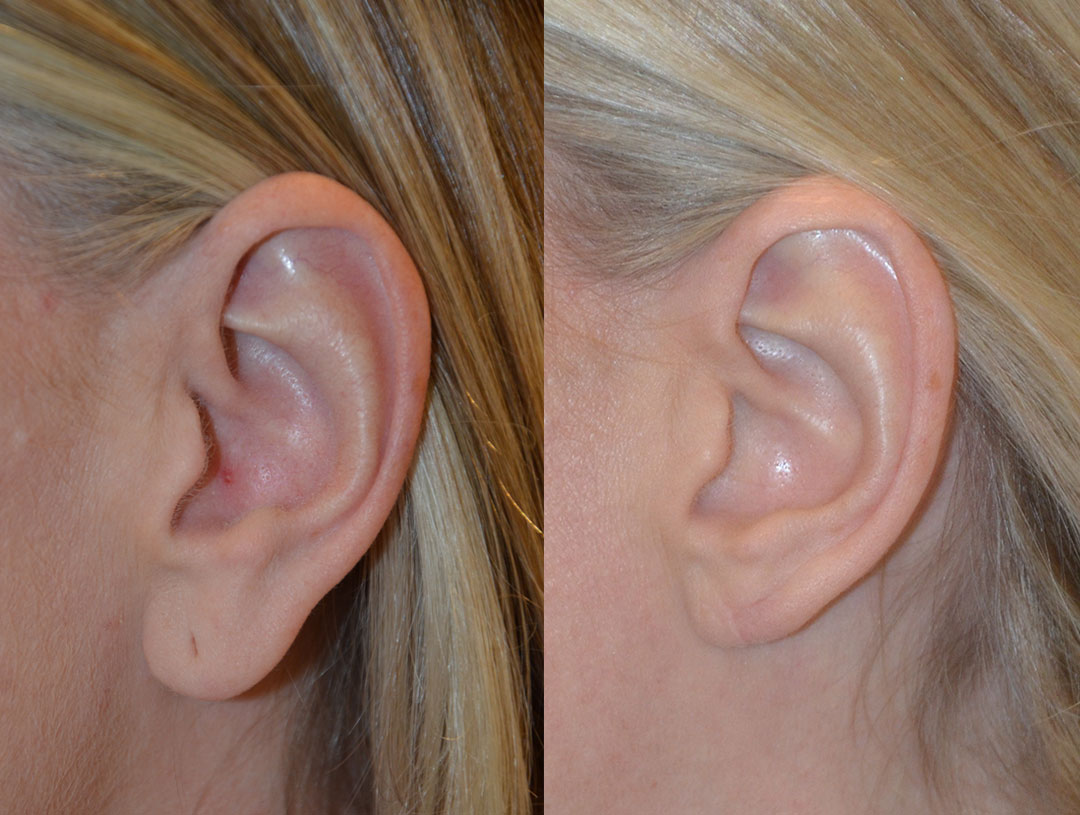 Side-by-side comparison of a person's ear before and after a surgical procedure of earlobe reduction