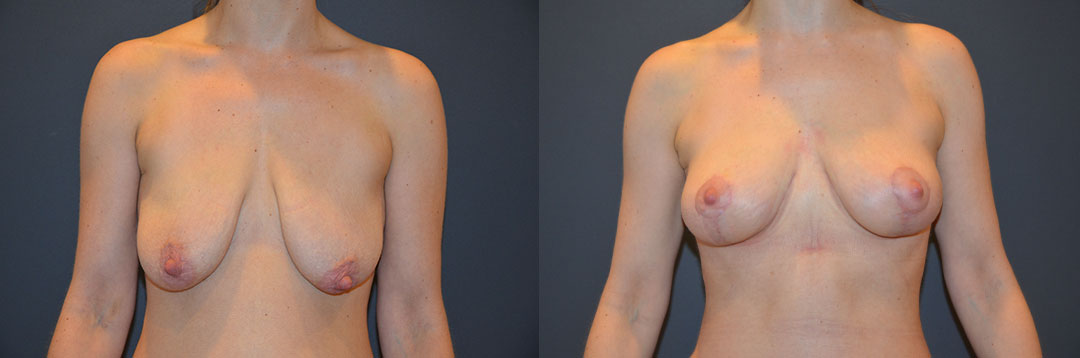 A woman is shown in before and after photos of breast surgery, displaying changes in size and shape.