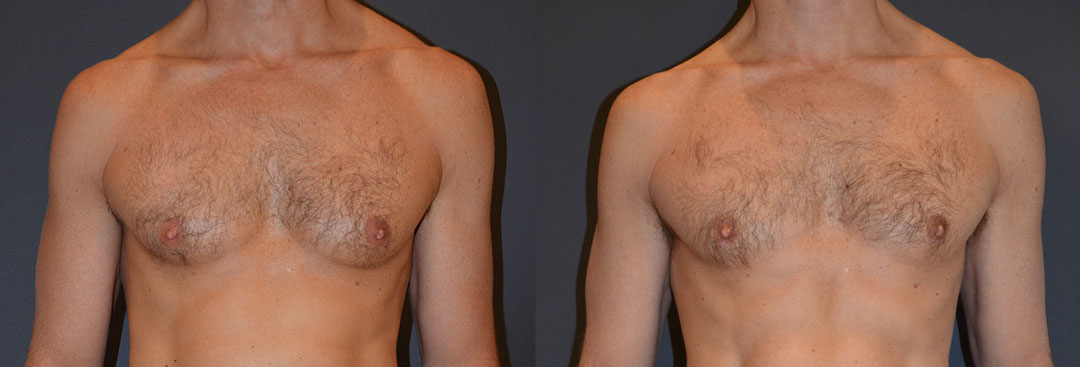 Comparison of a man's chest before and after gynecomastia 