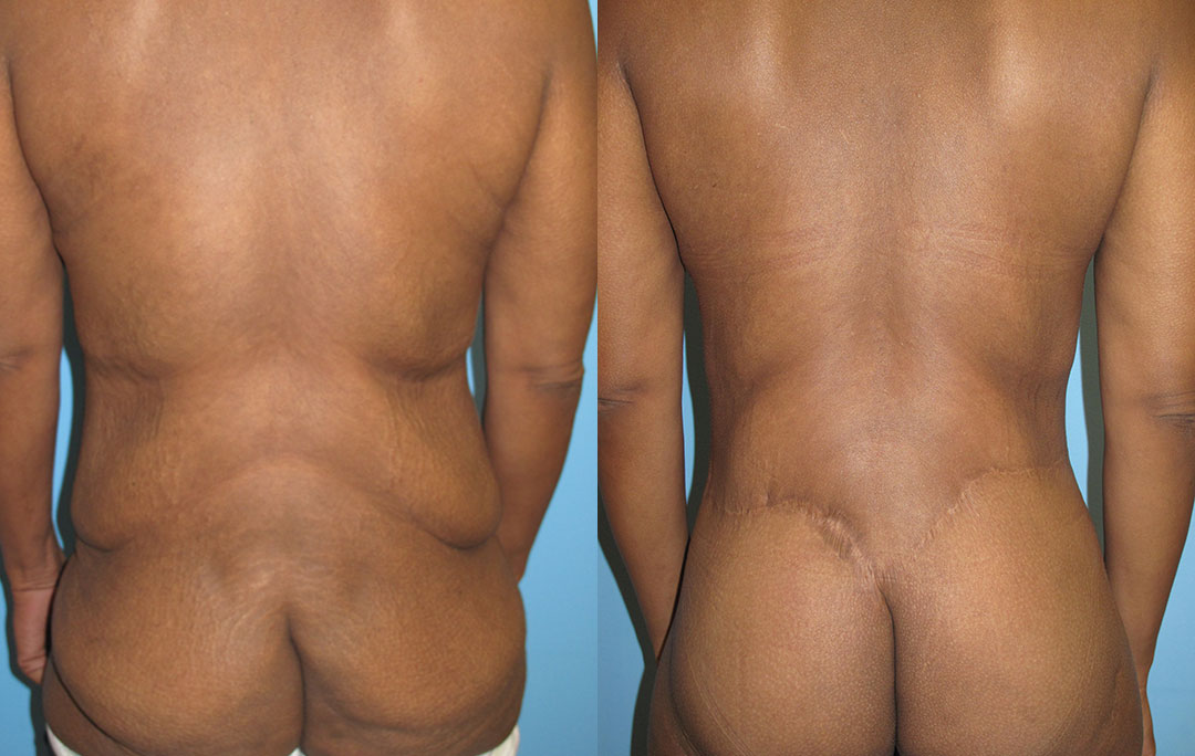 lower bodylift before and after photo
