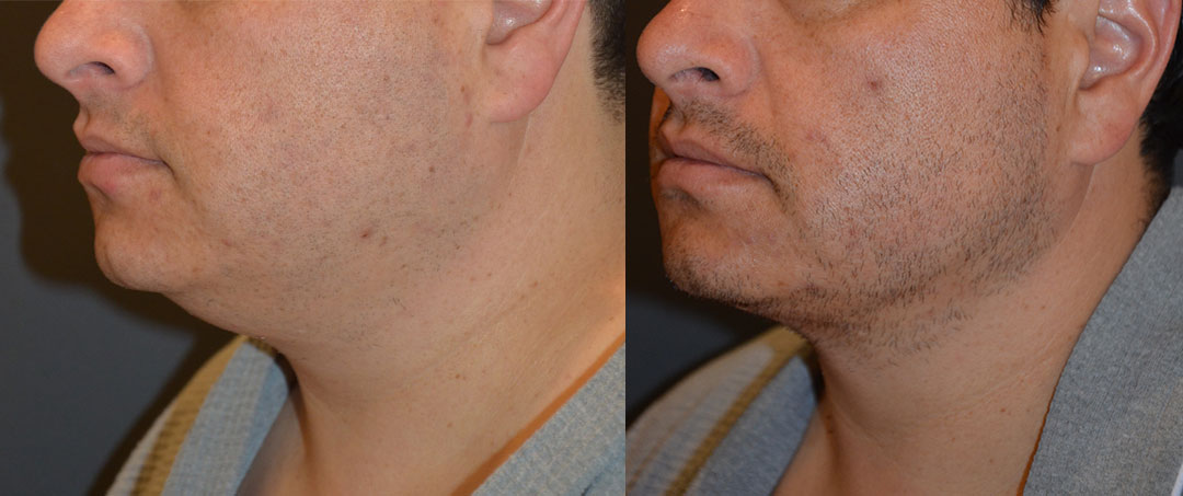 male chin lipo license confirmed