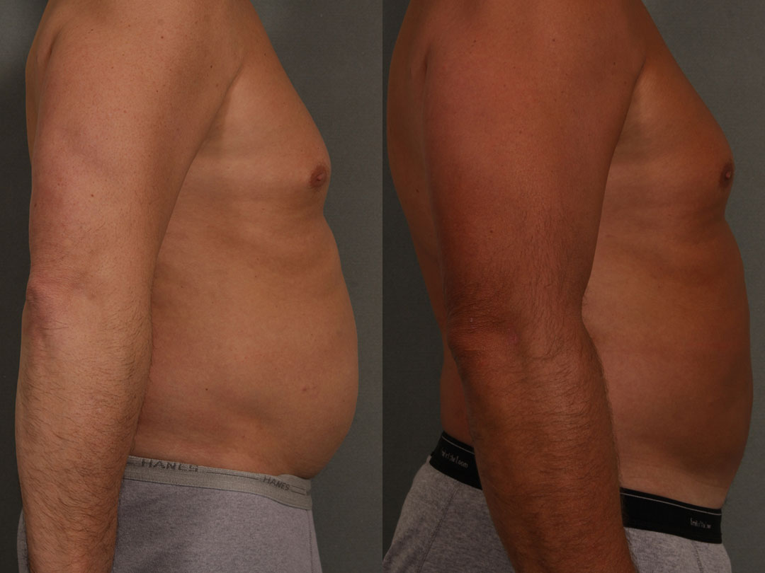 Side-by-side comparison of a person before and after liposuction