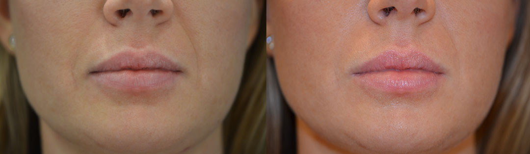 nasal fold filler license confirmed