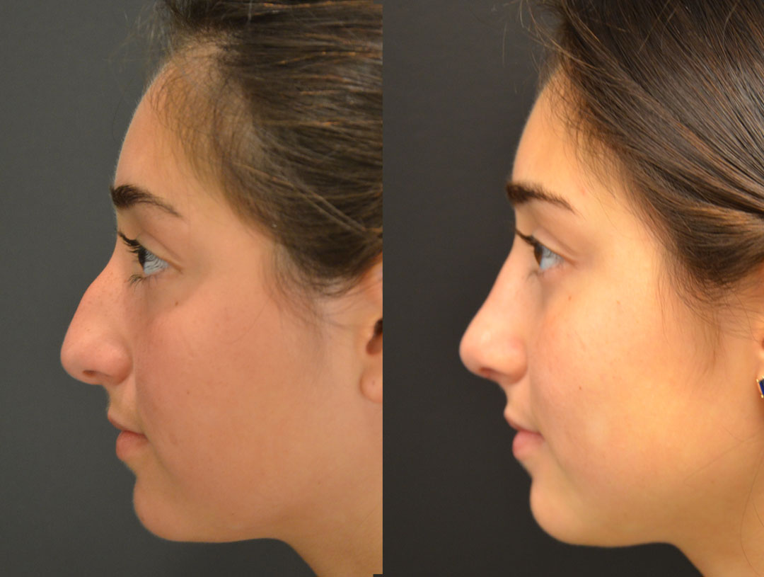Side-by-side profile images of a person before and after a rhinoplasty procedure, illustrating changes in the shape and contour of the nose.