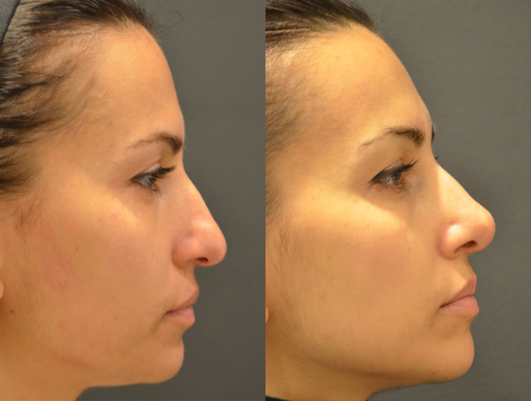 Side-by-side profile images of a person before and after a rhinoplasty procedure, illustrating changes in the shape and contour of the nose.