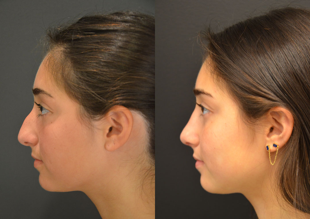 Side-by-side profile images of a woman before and after a rhinoplasty procedure, showing differences in the nose