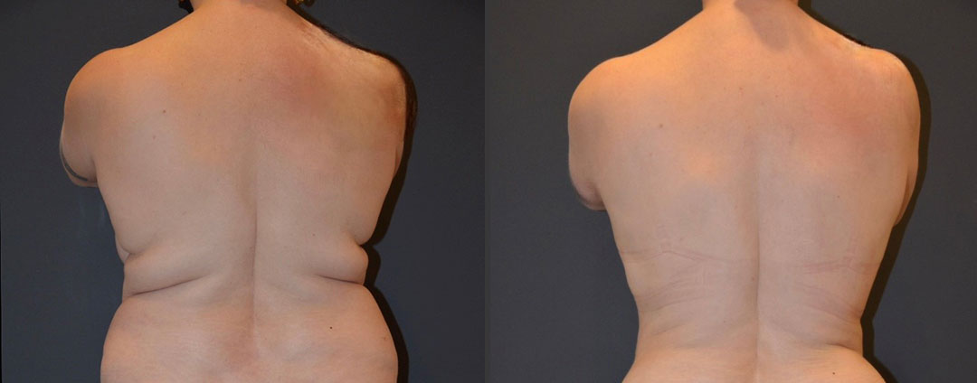 Bodytite lipo license confirmed