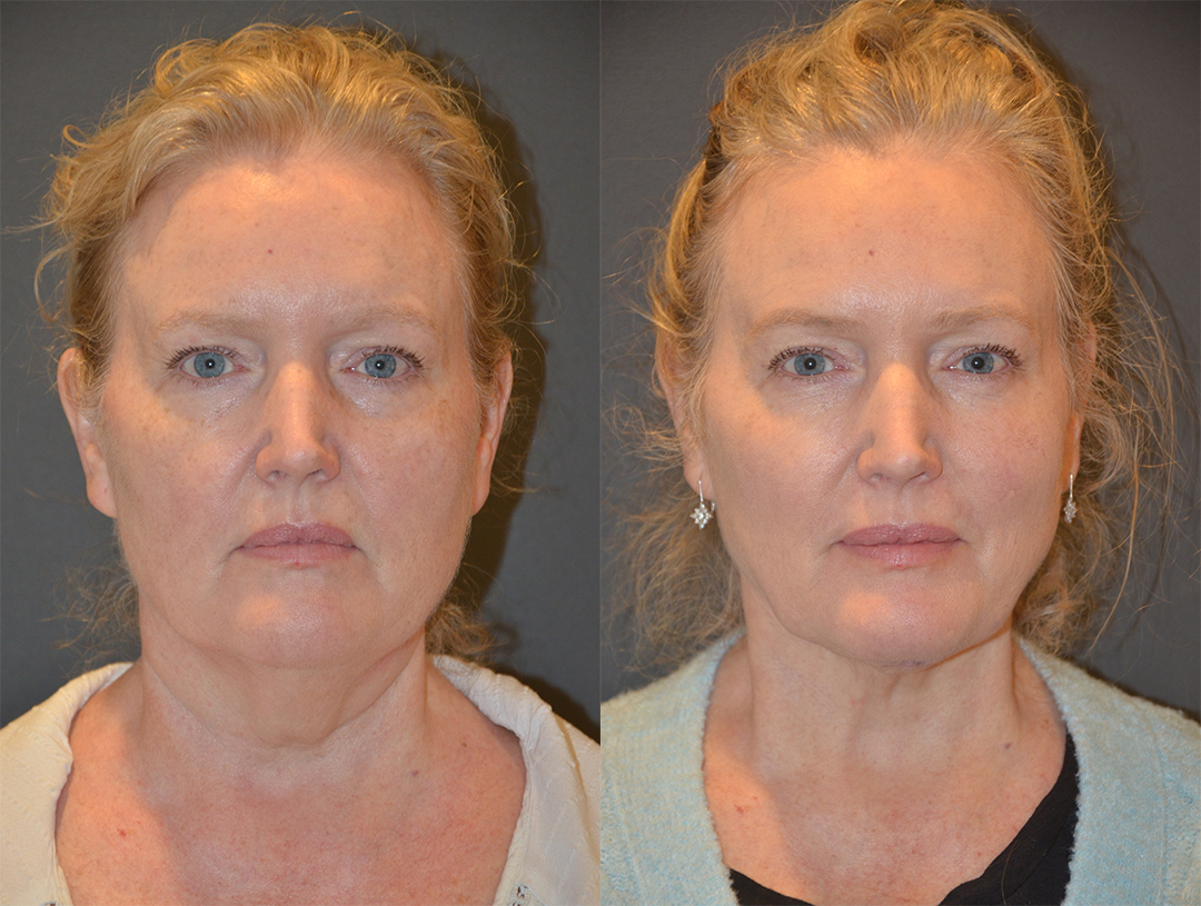 Facelift license confirmed