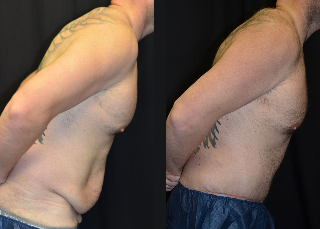 male tummy tuck