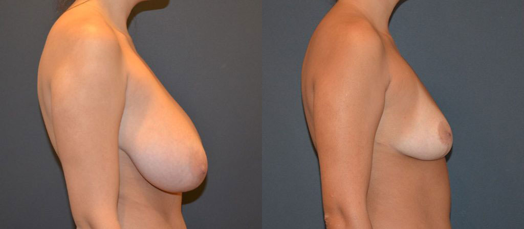 Before and after side view of a woman showing breast size reduction