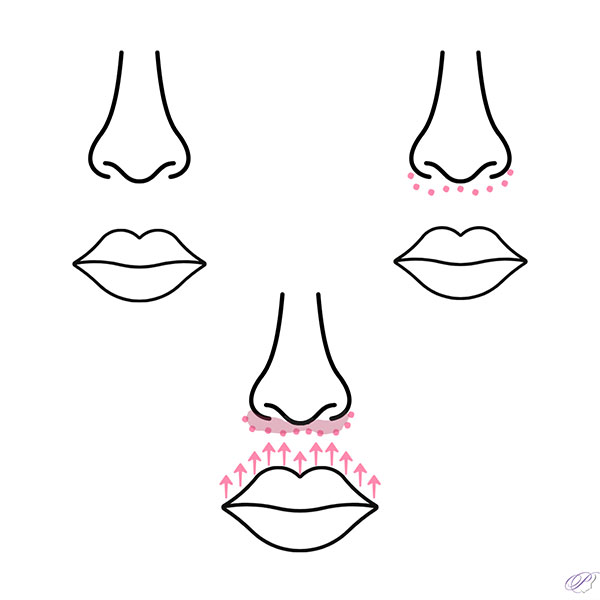 lip lift enhancement