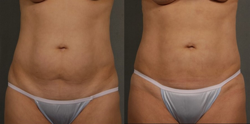 smart lipo before and after photos