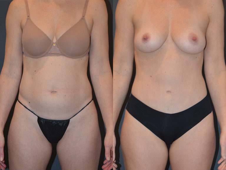 Tummy tuck before and after photos
