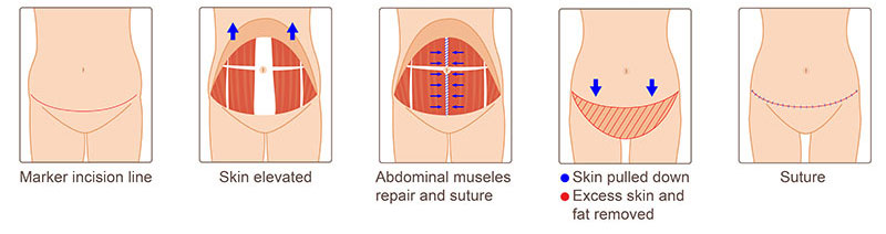 Step-by-step diagram of tummy tuck surgery showing: incision line marked, skin lifted, abdominal muscles repaired and sutured, excess skin and fat removed, and final sutured result.